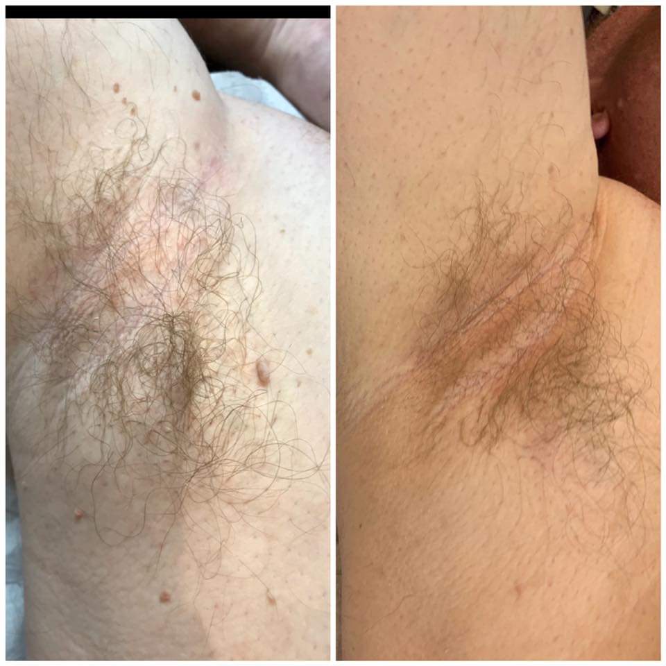 Skin tag before and after cryotherapy removal — Shell Davis
